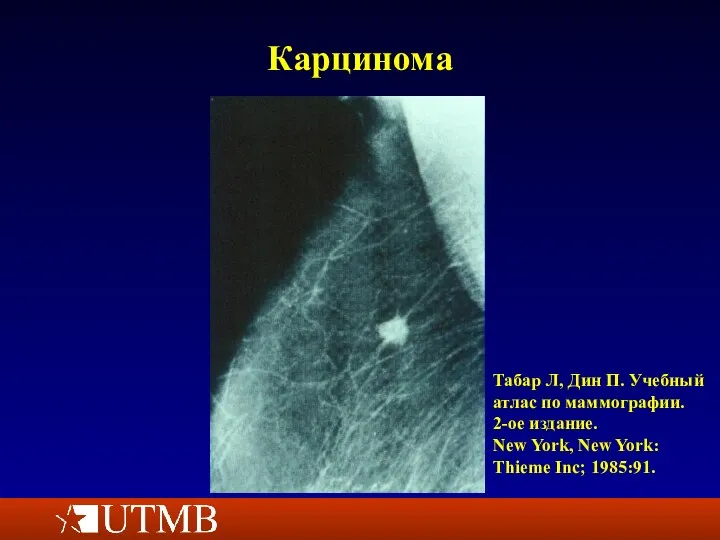 Карцинома Табар Л, Дин П. Учебный атлас по маммографии. 2-ое издание. New