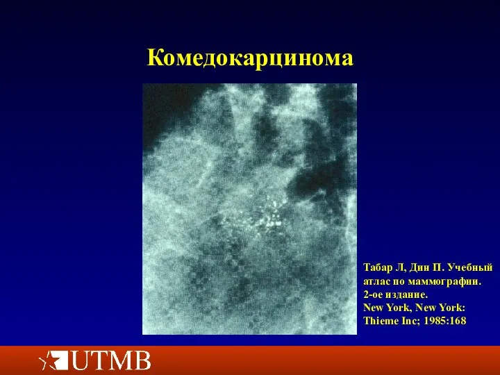 Комедокарцинома Табар Л, Дин П. Учебный атлас по маммографии. 2-ое издание. New