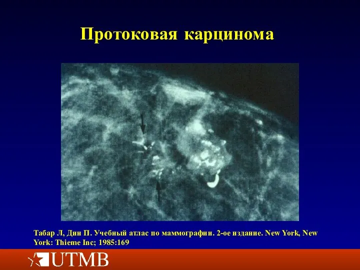 Протоковая карцинома Табар Л, Дин П. Учебный атлас по маммографии. 2-ое издание.