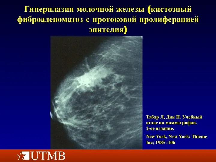 Гиперплазия молочной железы (кистозный фиброаденоматоз с протоковой пролиферацией эпителия) Табар Л, Дин
