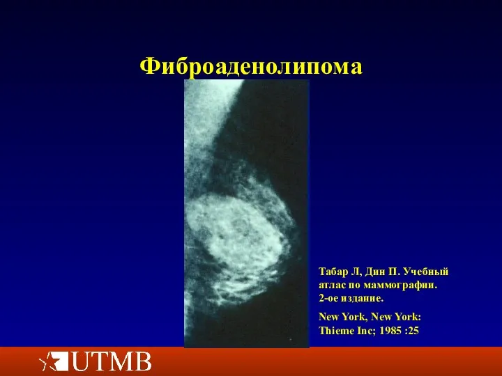 Фиброаденолипома Табар Л, Дин П. Учебный атлас по маммографии. 2-ое издание. New