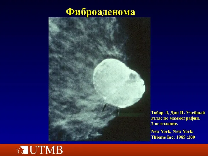 Фиброаденома Табар Л, Дин П. Учебный атлас по маммографии. 2-ое издание. New