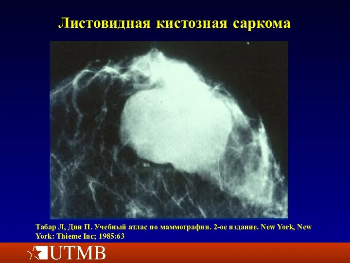 Листовидная кистозная саркома Табар Л, Дин П. Учебный атлас по маммографии. 2-ое