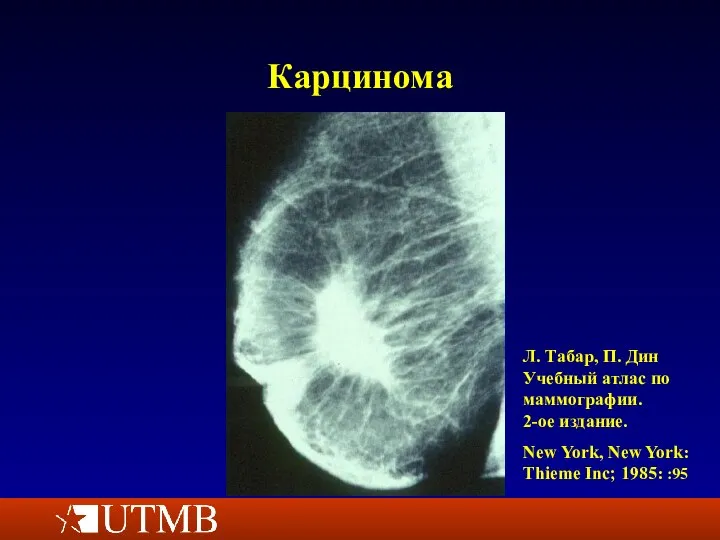 Карцинома Л. Табар, П. Дин Учебный атлас по маммографии. 2-ое издание. New