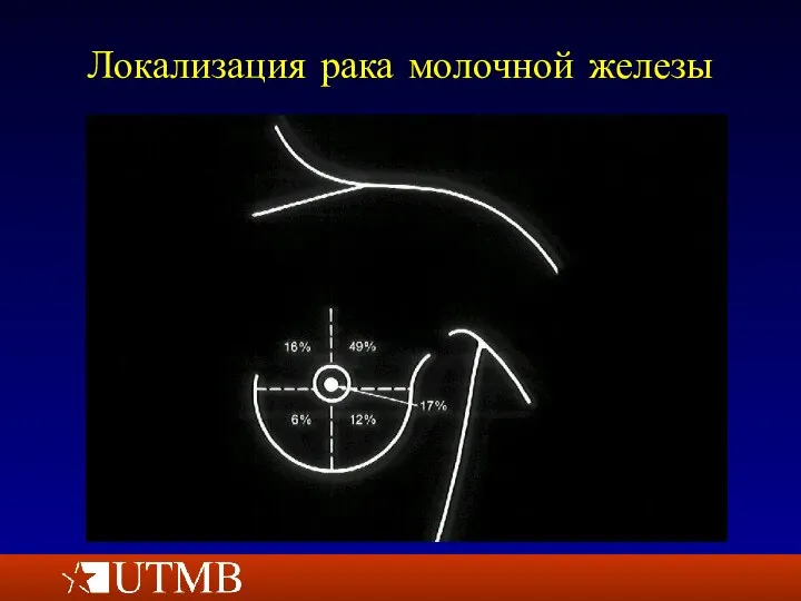 Локализация рака молочной железы