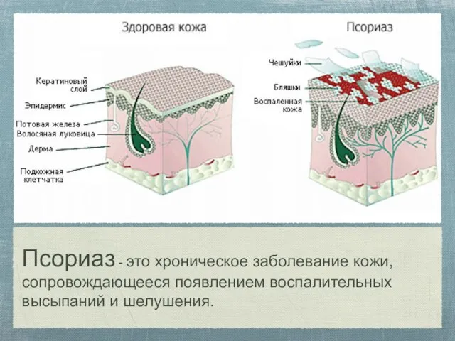 Псориаз - это хроническое заболевание кожи, сопровождающееся появлением воспалительных высыпаний и шелушения.