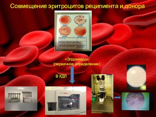 Совмещение эритроцитов реципиента и донора «Элдонкард» (первичное определение) В КДЛ