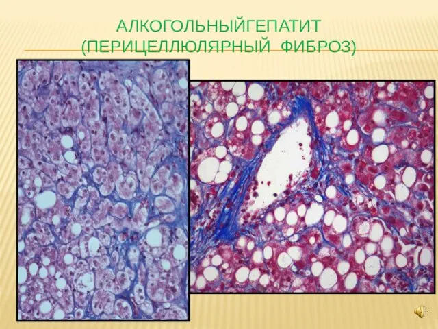 АЛКОГОЛЬНЫЙГЕПАТИТ (ПЕРИЦЕЛЛЮЛЯРНЫЙ ФИБРОЗ)