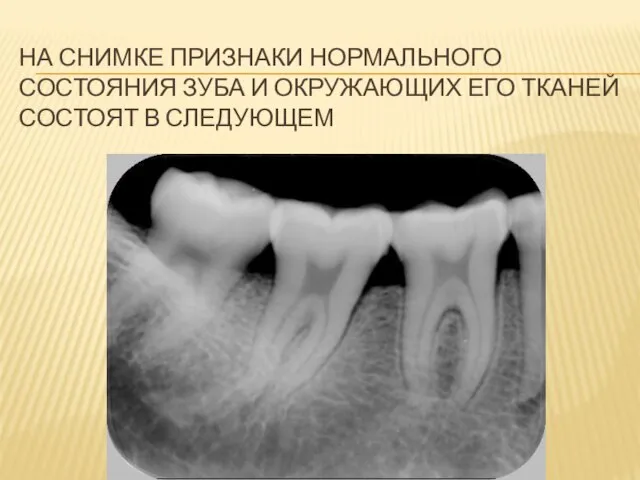 НА СНИМКЕ ПРИЗНАКИ НОРМАЛЬНОГО СОСТОЯНИЯ ЗУБА И ОКРУЖАЮЩИХ ЕГО ТКАНЕЙ СОСТОЯТ В СЛЕДУЮЩЕМ