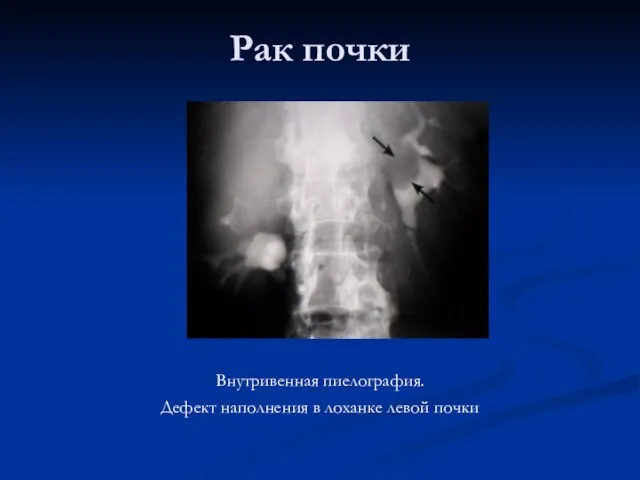 Рак почки Внутривенная пиелография. Дефект наполнения в лоханке левой почки