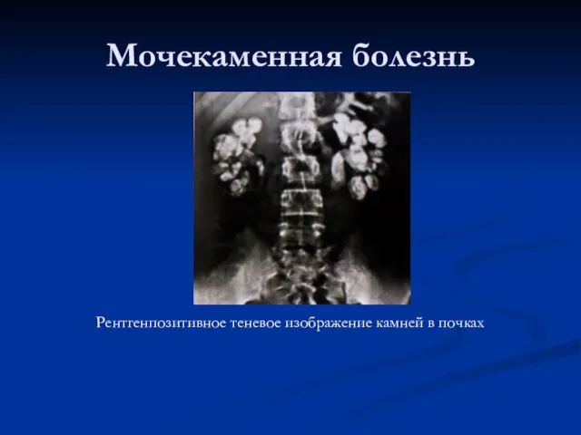 Мочекаменная болезнь Рентгенпозитивное теневое изображение камней в почках