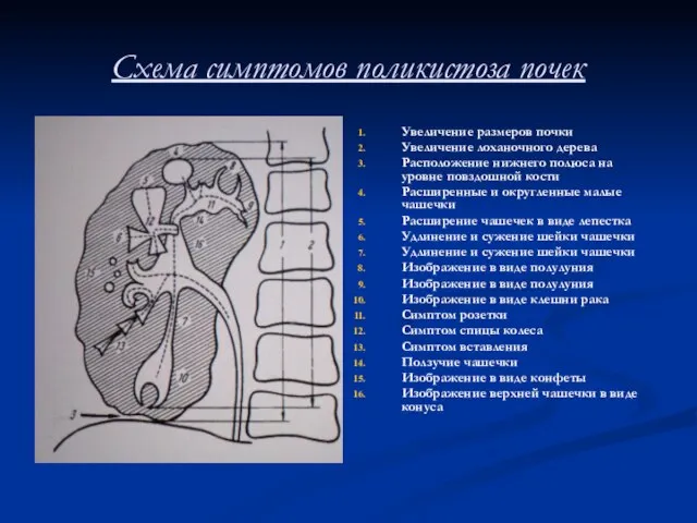 Схема симптомов поликистоза почек Увеличение размеров почки Увеличение лоханочного дерева Расположение нижнего