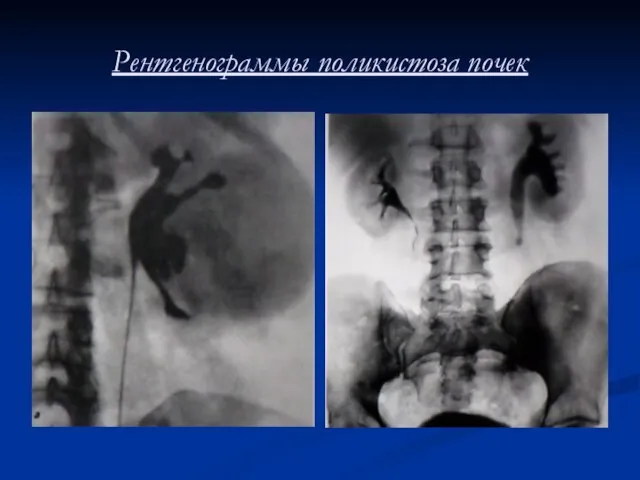 Рентгенограммы поликистоза почек