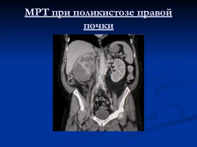 МРТ при поликистозе правой почки