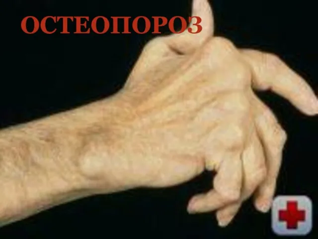 ОСТЕОПОРОЗ