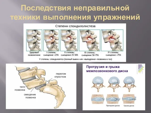 Последствия неправильной техники выполнения упражнений