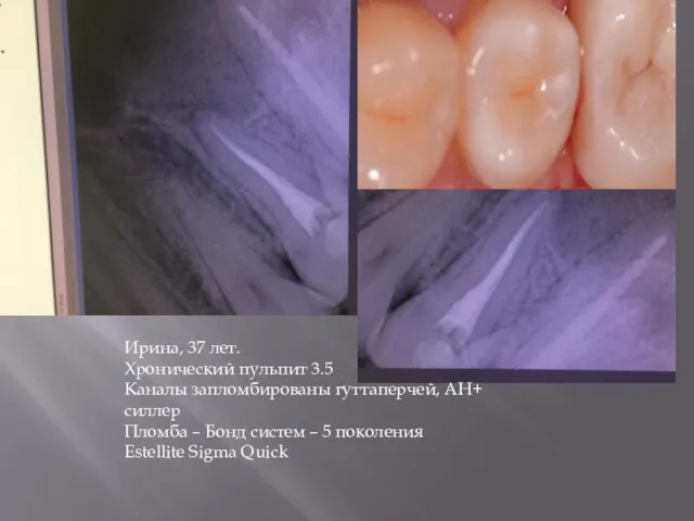 Ирина, 37 лет. Хронический пульпит 3.5 Каналы запломбированы гуттаперчей, АН+ силлер Пломба