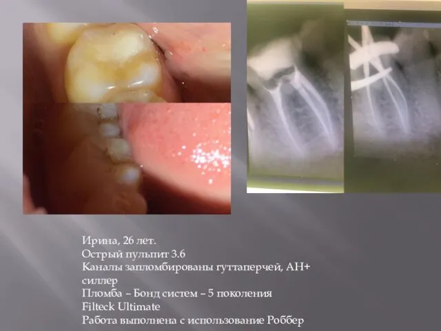 Ирина, 26 лет. Острый пульпит 3.6 Каналы запломбированы гуттаперчей, АН+ силлер Пломба