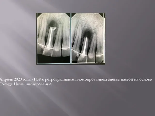 Апрель 2020 года - РВК с ретрограднымм пломбированием апекса пастой на основе Оксида Цина, шинирование.