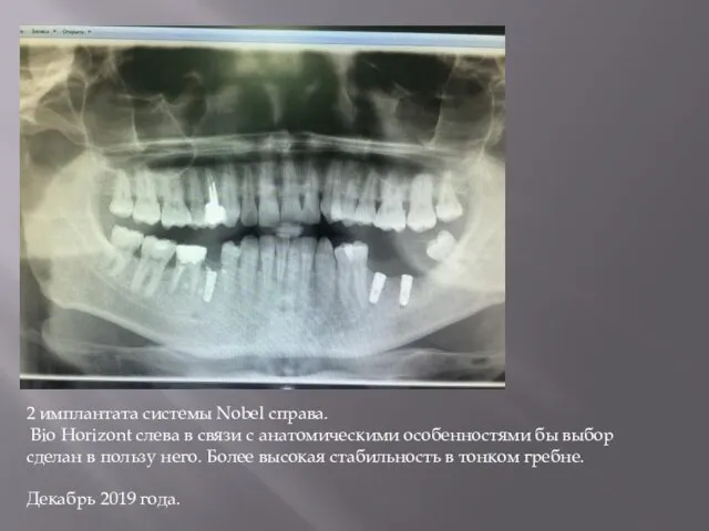 2 имплантата системы Nobel справа. Bio Horizont слева в связи с анатомическими