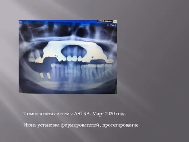 2 имплантата системы ASTRA. Март 2020 года Июнь установка формирователей , протезирование.