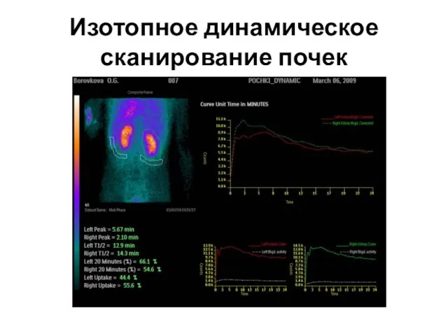 Изотопное динамическое сканирование почек