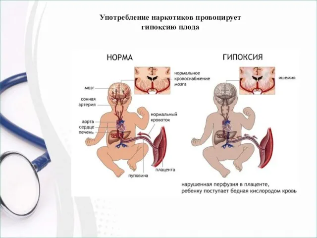 Употребление наркотиков провоцирует гипоксию плода