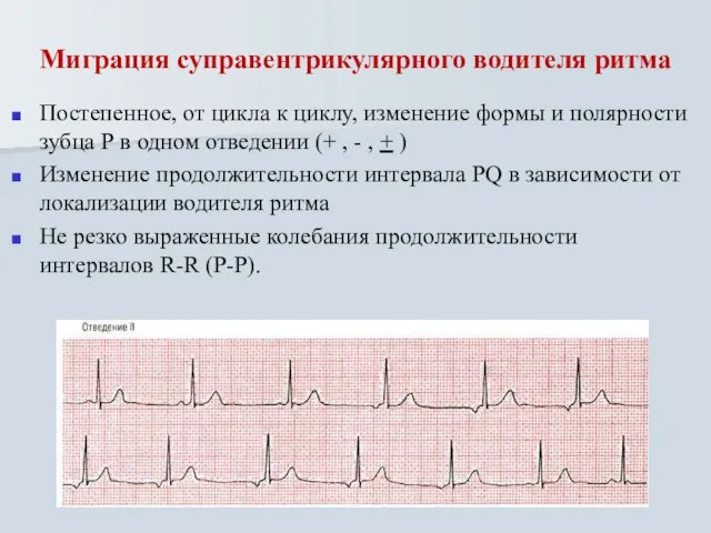 Миграция суправентрикулярного водителя ритма Постепенное, от цикла к циклу, изменение формы и