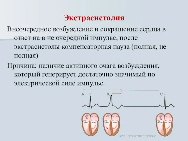 Экстрасистолия Внеочередное возбуждение и сокращение сердца в ответ на в не очередной