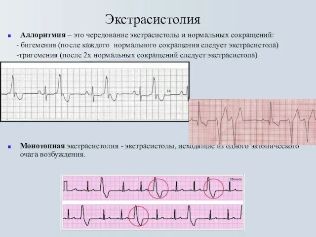 Экстрасистолия Аллоритмия – это чередование экстрасистолы и нормальных сокращений: - бигемения (после