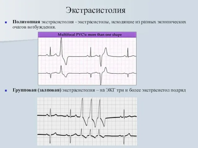 Экстрасистолия Политопная экстрасистолия - экстрасистолы, исходящие из разных эктопических очагов возбуждения. Групповая