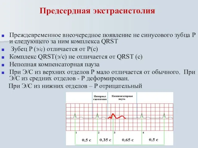 Предсердная экстрасистолия Преждевременное внеочередное появление не синусового зубца Р и следующего за