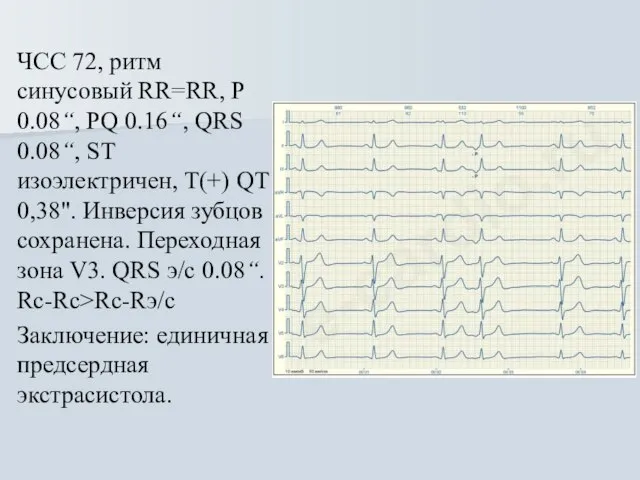 ЧСС 72, ритм синусовый RR=RR, Р 0.08“, PQ 0.16“, QRS 0.08“, ST