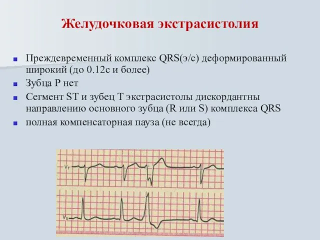 Желудочковая экстрасистолия Преждевременный комплекс QRS(э/с) деформированный широкий (до 0.12с и более) Зубца