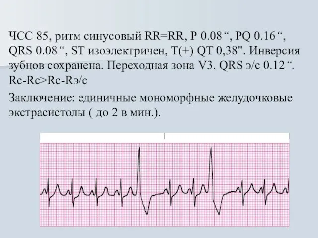 ЧСС 85, ритм синусовый RR=RR, Р 0.08“, PQ 0.16“, QRS 0.08“, ST