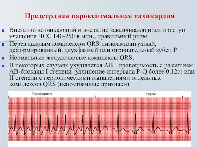 Предсердная пароксизмальная тахикардия Внезапно возникающий и внезапно заканчивающийся приступ учащения ЧСС 140-250