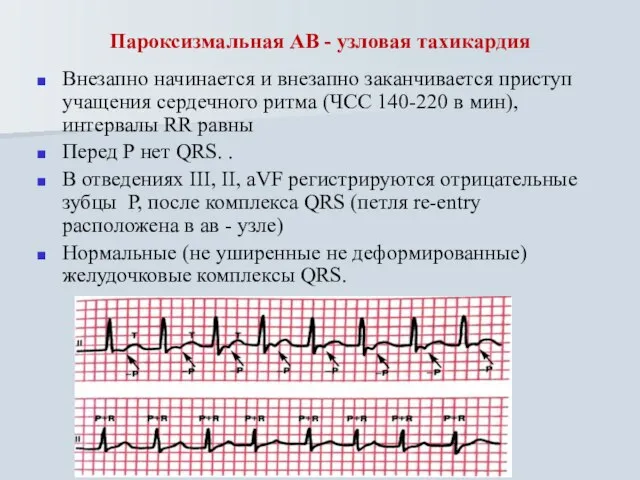 Пароксизмальная АВ - узловая тахикардия Внезапно начинается и внезапно заканчивается приступ учащения