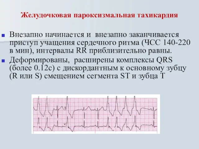 Желудочковая пароксизмальная тахикардия Внезапно начинается и внезапно заканчивается приступ учащения сердечного ритма
