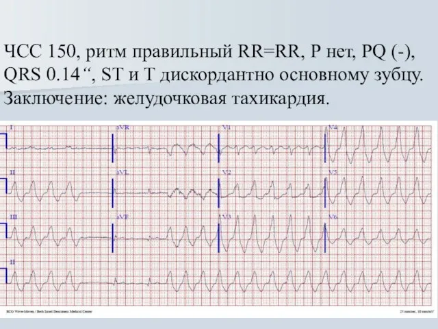 ЧСС 150, ритм правильный RR=RR, Р нет, PQ (-), QRS 0.14“, ST