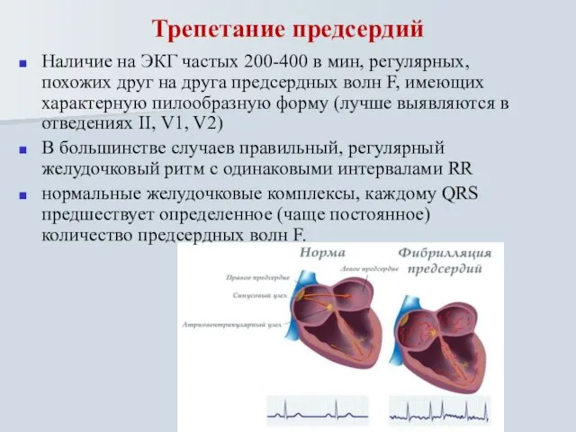 Трепетание предсердий Наличие на ЭКГ частых 200-400 в мин, регулярных, похожих друг