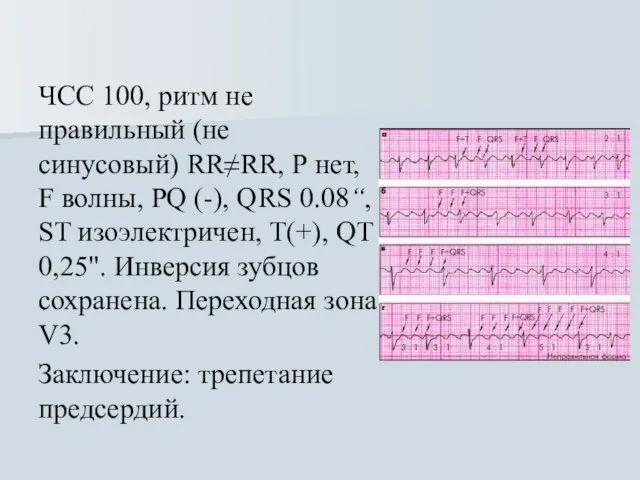 ЧСС 100, ритм не правильный (не синусовый) RR≠RR, Р нет, F волны,