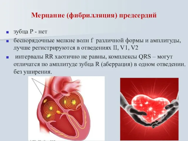 Мерцание (фибрилляция) предсердий зубца Р - нет беспорядочные мелкие волн f различной