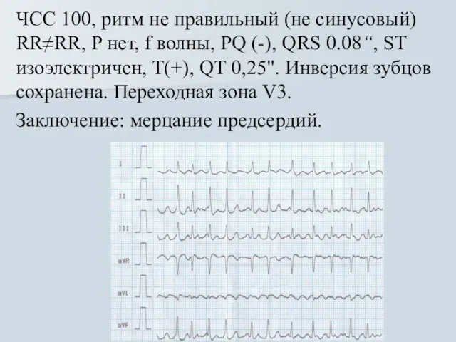 ЧСС 100, ритм не правильный (не синусовый) RR≠RR, Р нет, f волны,