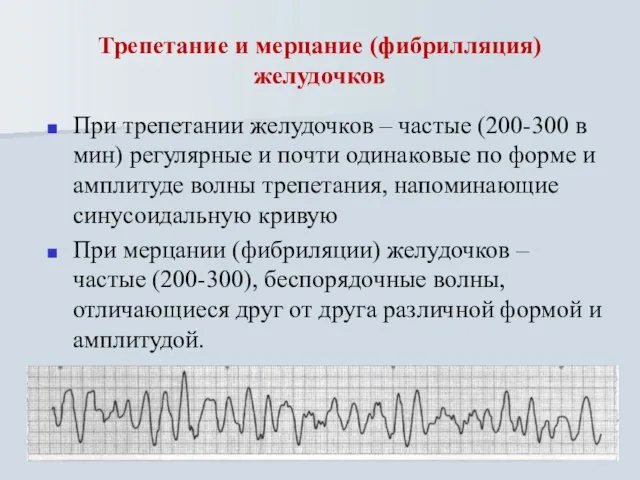 Трепетание и мерцание (фибрилляция) желудочков При трепетании желудочков – частые (200-300 в