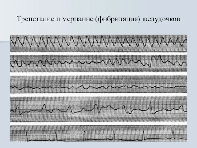 Трепетание и мерцание (фибриляция) желудочков