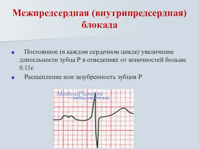Межпредсердная (внутрипредсердная) блокада Постоянное (в каждом сердечном цикле) увеличение длительности зубца Р