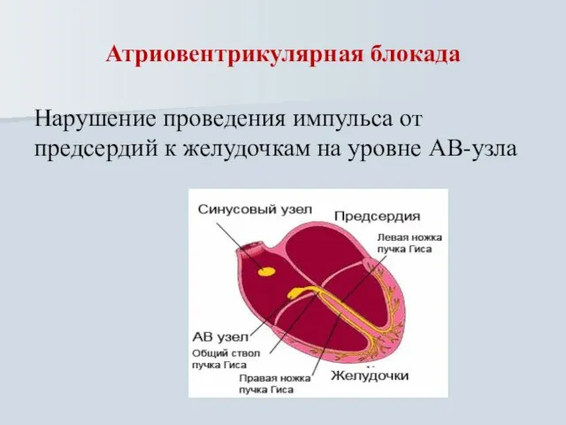 Атриовентрикулярная блокада Нарушение проведения импульса от предсердий к желудочкам на уровне АВ-узла