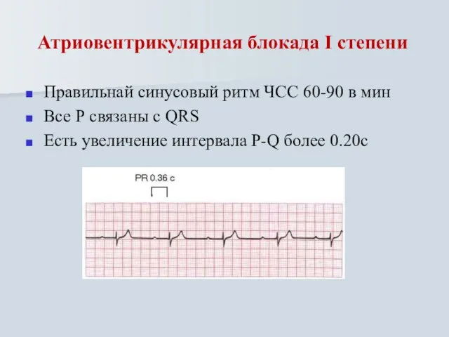 Атриовентрикулярная блокада I степени Правильнай синусовый ритм ЧСС 60-90 в мин Все