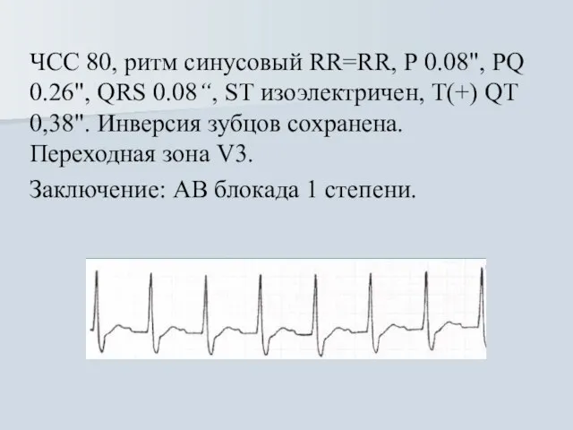 ЧСС 80, ритм синусовый RR=RR, Р 0.08", PQ 0.26", QRS 0.08“, ST
