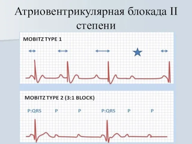 Атриовентрикулярная блокада II степени